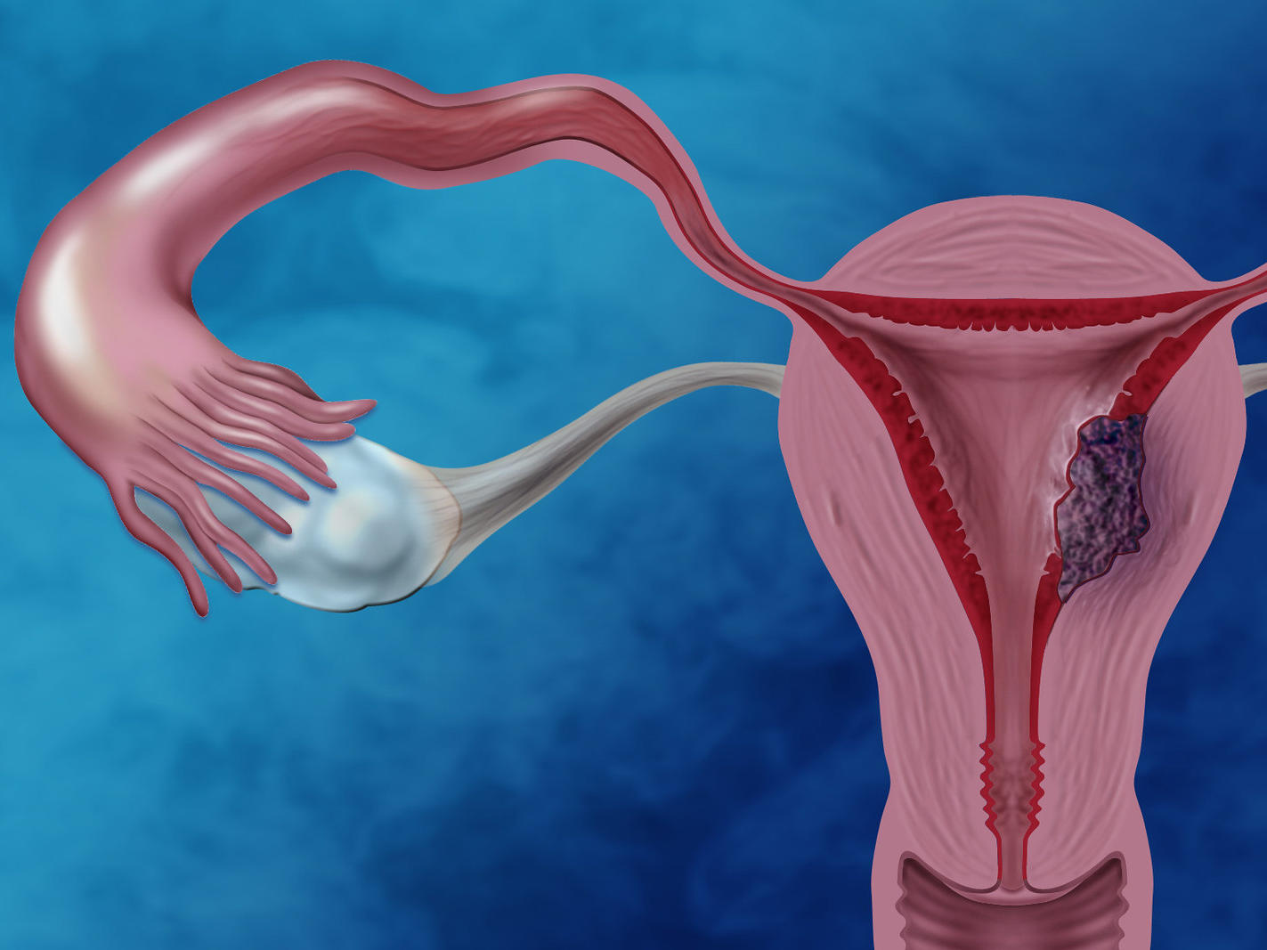 endometrial cancer concept image